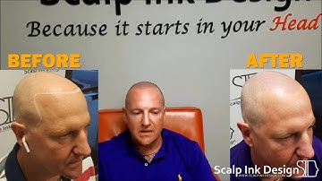 Get your hairline back with Scalp Micropigmentation! Vito