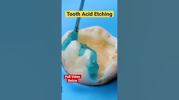 Thumbnail of Tooth Acid Etching #shorts