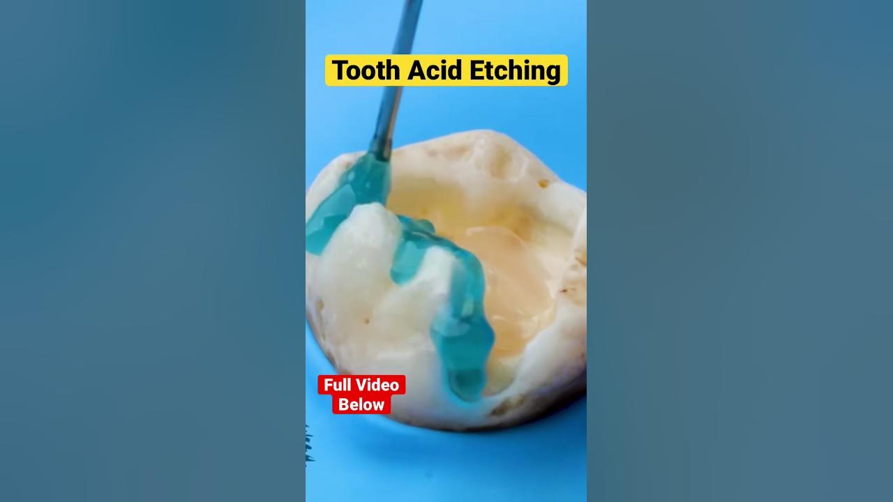 Tooth Acid Etching #shorts Tooth Acid Etching #shorts
