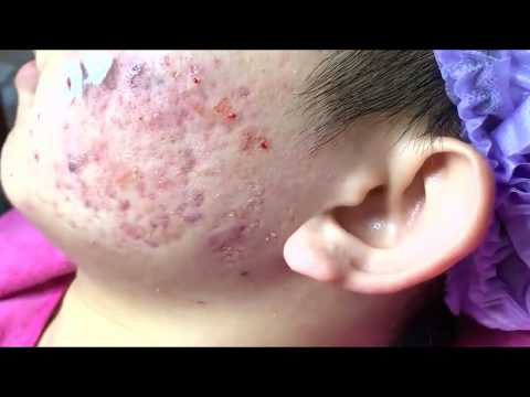 HUGE CYSTIC ACNE EXTRACTION #