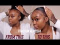 Beginner Friendly: How To Achieve Braided Ponytail with Traction Alopecia 
| Yvonne Queen |