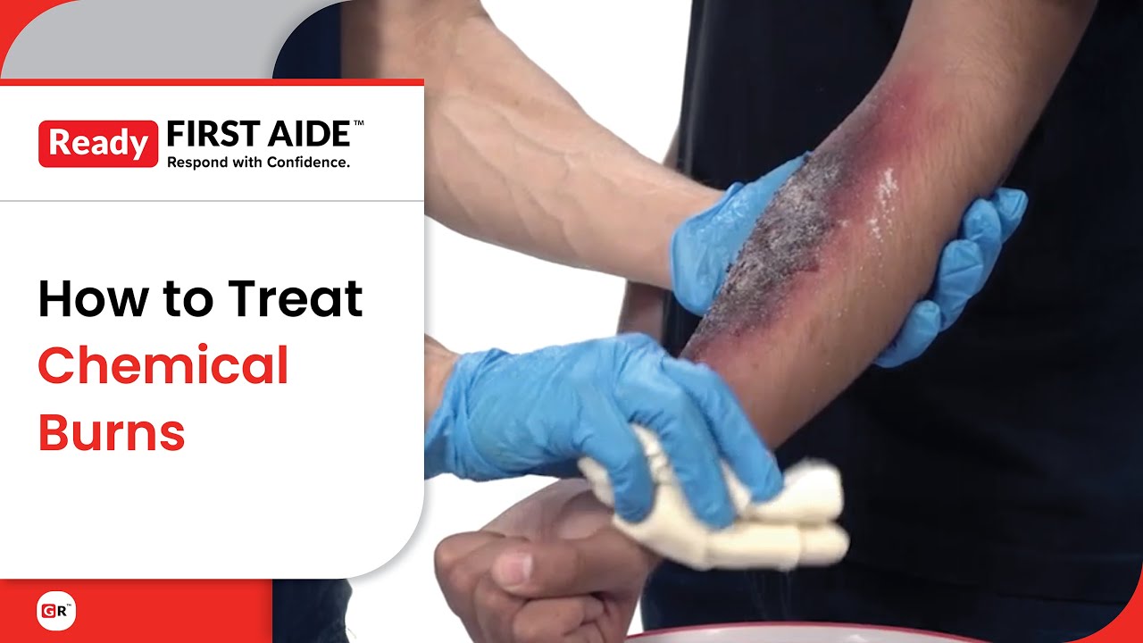 How to Treat Chemical Burns | First Aid for Acid and Chemical Injuries ...