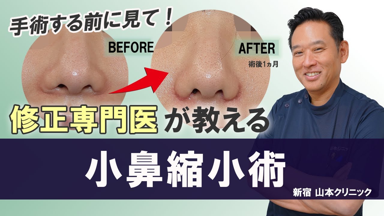 【修正専門医が教える】小鼻縮小術【手術する前にみて！】