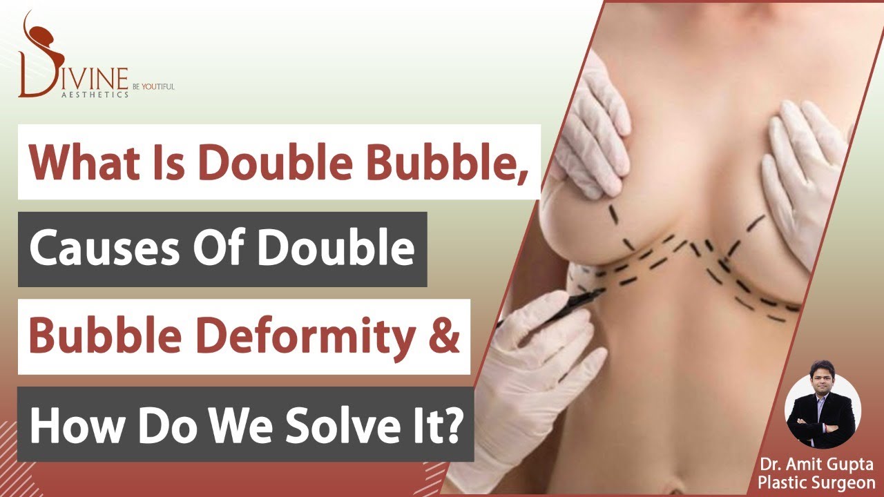 What is a Double Bubble, What Causes Double Bubble Deformity & How Do We Solve it?