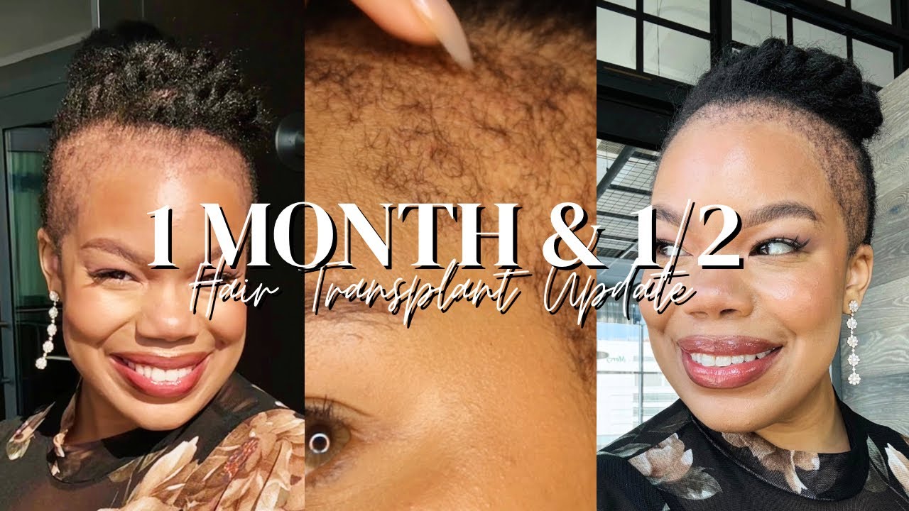 1 1/2 Month Update Hair Transplant Post Op 48(Rigged Audio here&there)