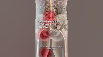 Are Gluteus Minimus Trigger Points Causing Your Leg Pain?