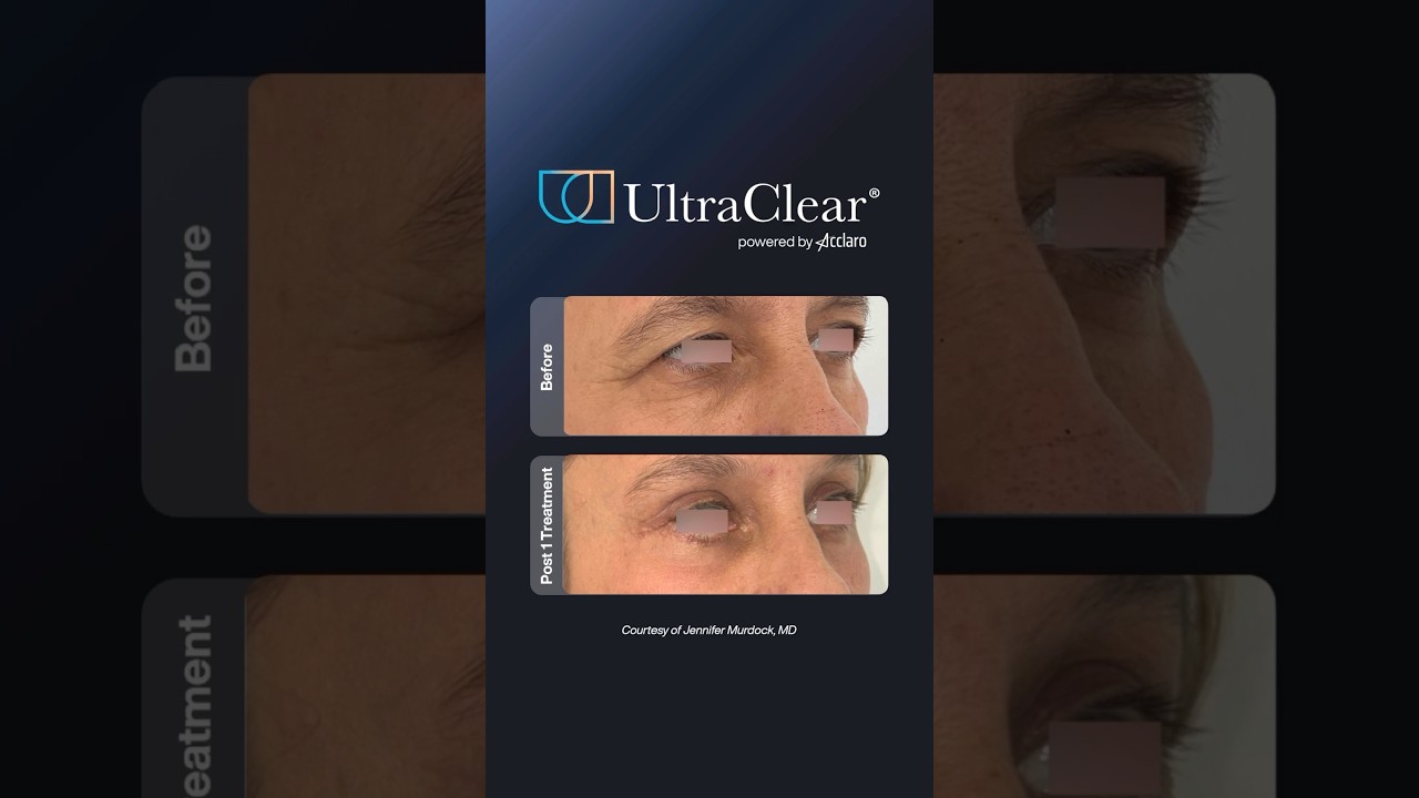 What surgery can’t address, UltraClear can. 👁️✨