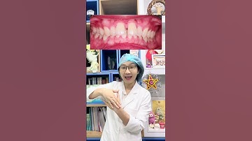 Niềng răng là chân ái