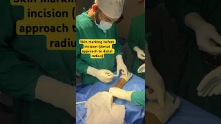 Skin Marking Before Incisiondorsal Approach To Distal Radius