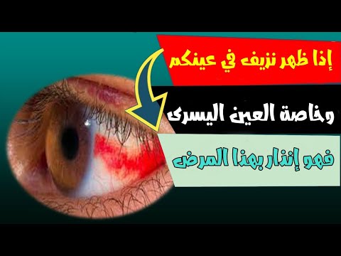 إذا ظهر نزيف في عينكم وخاصة العين اليسرى فهو إنذار بهذا المرض