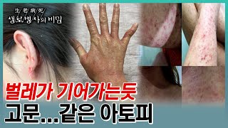 몸에 벌레가 기어가는 것 같이 가려워 긁으면 가려움이 몇십 배로 커지고, 긁다 보면 피부에 상처와 피가 나며 악순환이 되는데... (KBS 20230628 방송)