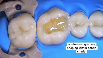 From A to Z class II composite restoration "mastering class 2 composite"