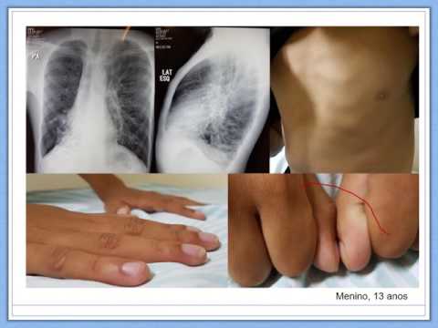 Vídeo: Informação, Educação E Autogestão Do Paciente Em Bronquiectasias: Facilitando Melhorias Para Otimizar Os Resultados De Saúde