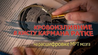 ЭКТОПИЯ миндалин мозжечка и КРОВОИЗЛИЯНИЕ мозга в кисту кармана Ратке на РАСШИФРОВКЕ МРТ головы