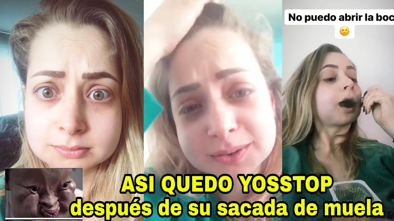 cara hinchada por muela del juicio
