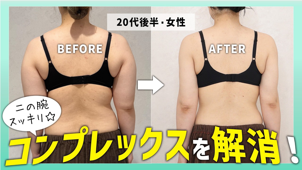 「体重を落としてから」と言われた二の腕｜脂肪吸引して半年間のリアルな声