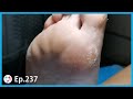 Ep.237 - A Big Foot Pads Got Peeling