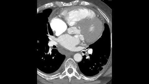 Rare subtype of caseous necrosis of the mitral annulus/valve with atypical extension.