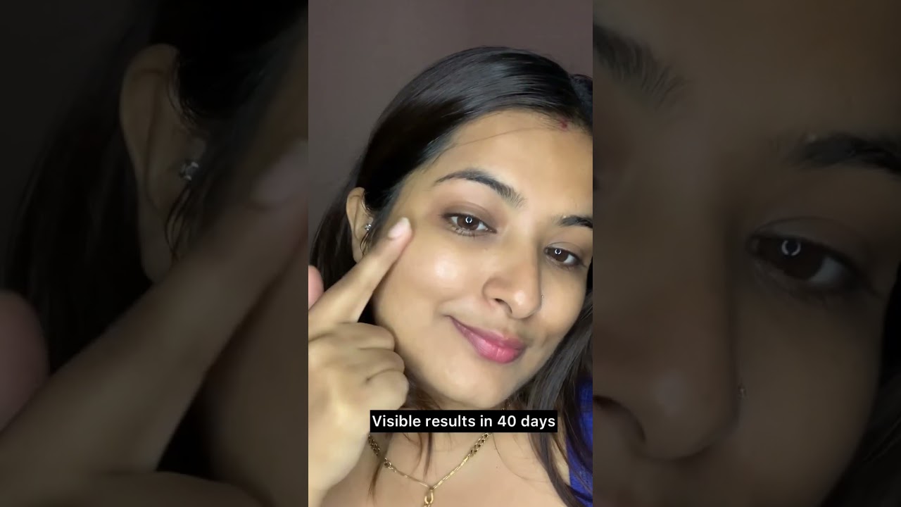 One Solution for Acne Marks and Pores! 