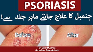 Psoriasis Treatment In Urdu (Chambal Ka Ilaj) | By Dr. Umer Mushtaq - Best Skin Specialist