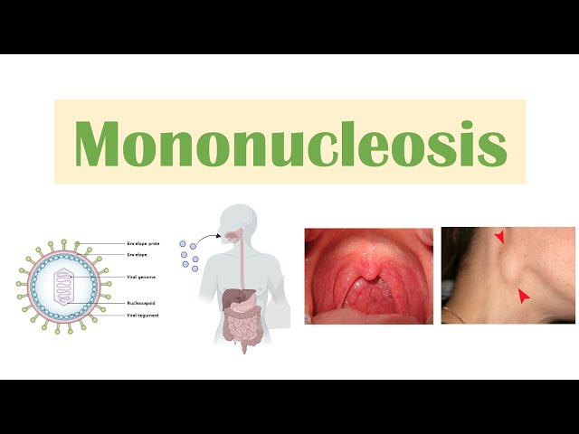 Infectious Mononucleosis (Mono)  Epstein-Barr Virus, Transmission,  Symptoms, Diagnosis, Treatment 