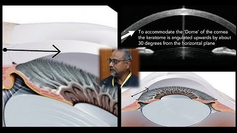 A Simplified way to create the Clear Corneal Incision - The Flat Cut