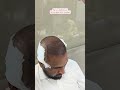 Alhamdulillah Ful Head HairTransplant Successfully Completed #haircare #hairtransplant #gulberggreen