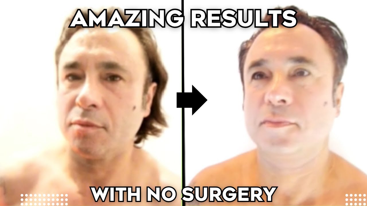 REMARKABLE face and torso non surgical transformation results 2024!!!