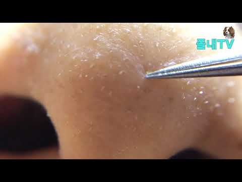 피지뽑기 제3화/Whitehead, blackhead removal video.