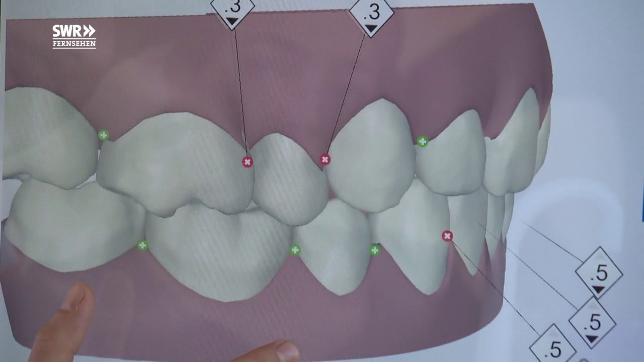 Zahnkorrektur für Erwachsene - YouTube