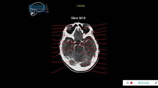 BASIC CT ANATOMY OF THE BRAIN WITH SOFT WINDOW screenshot 3