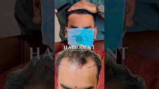 3400 ഗ്രാഫ്റ്റ് ചെയ്തു 6 മാസം കഴിയുമ്പോൾ ✅ #drsreenath #hairodent #hairtransformation
