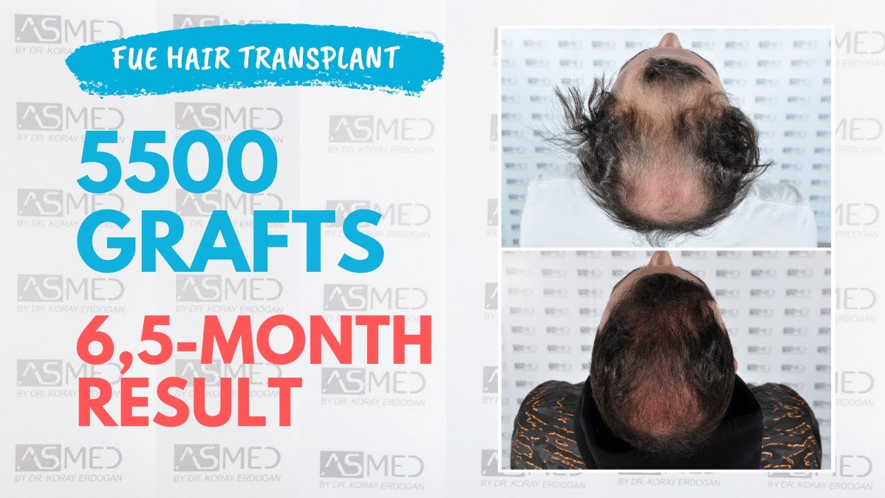 Manual FUE Hair Transplant Before & After 5500 Grafts 6.5-Month Result - ASMED - Dr. Koray Erdogan