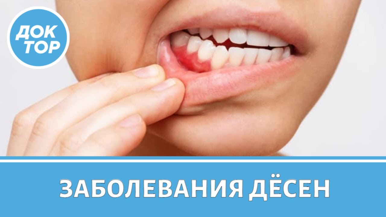 Проблемы с дёснами: причины и симптомы - YouTube