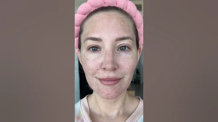 Day 1-8 Healing from Secret RF Microneedling