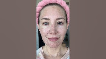 Day 1-8 Healing from Secret RF Microneedling
