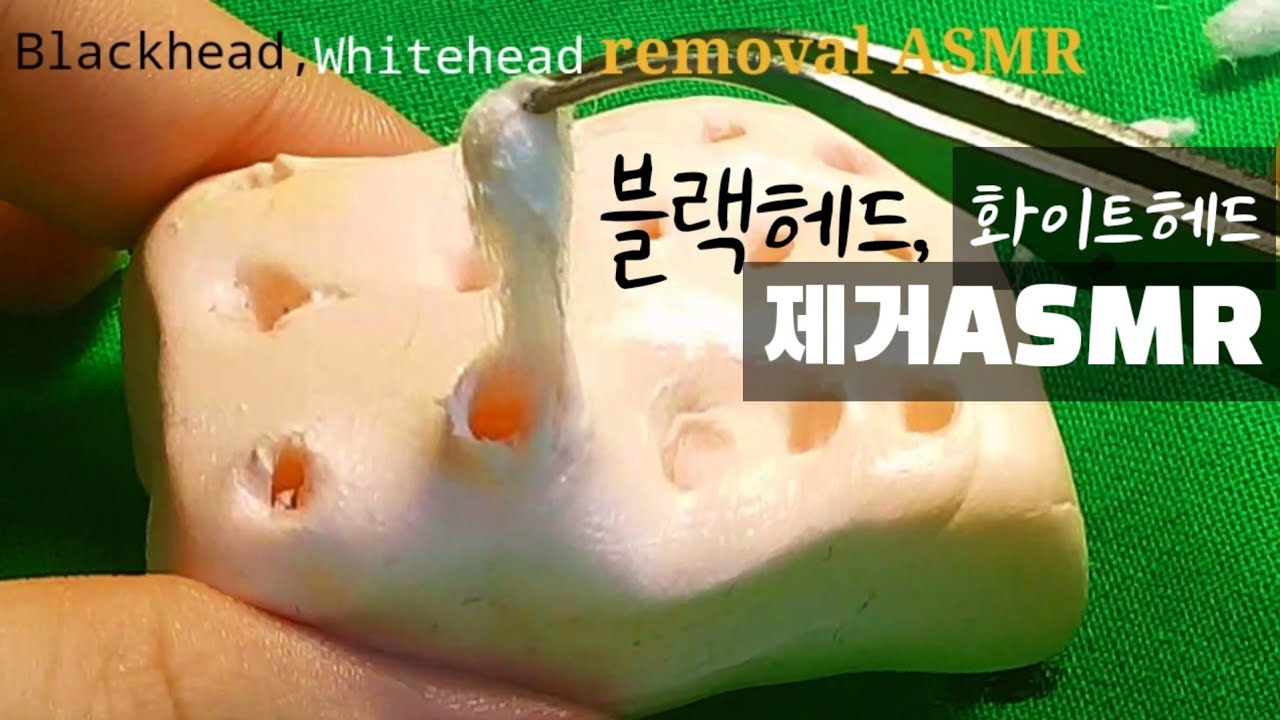 블렉헤드, 화이트헤드 제거 asmr