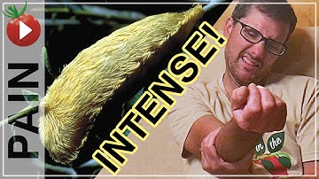 I Was Stung By An ASP  - The FURRY PUSS CATERPILLAR!