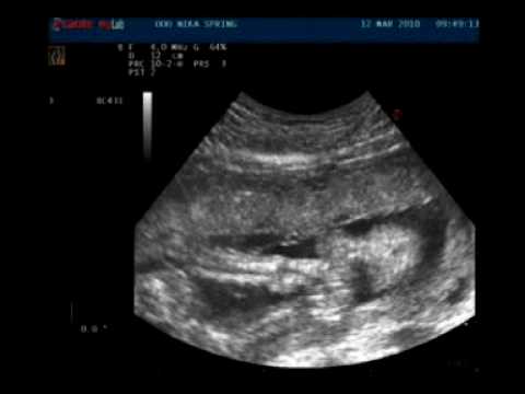 УЗИ 24 недели - мальчик sonogram 24 week - boy