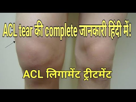 ACL Tear in Hindi | घुटने की ACL लिगामेंट्स के बारे में पूरी जानकारी | ACL tear and Sports Injury |