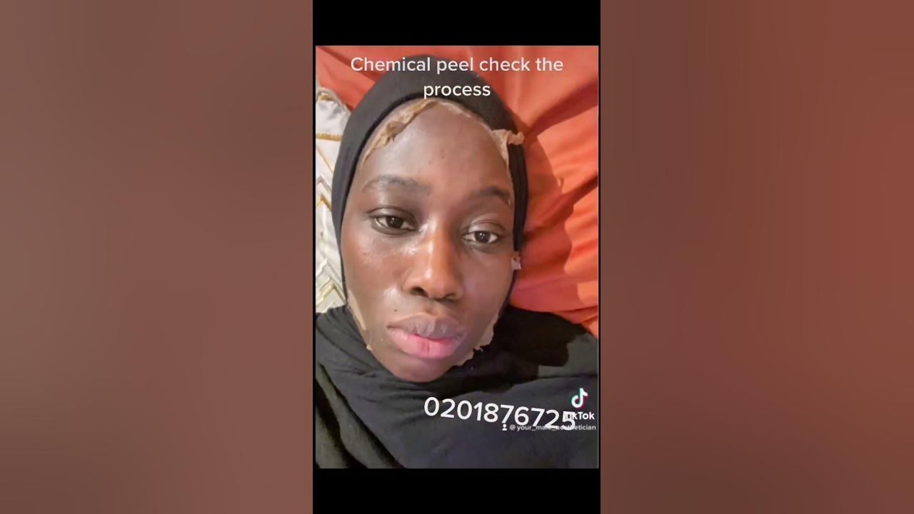 Chemical peel on face #reels #trending #viral #foryou