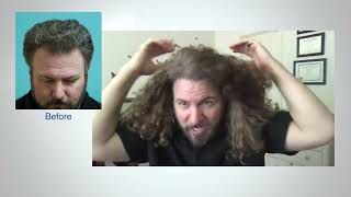 Hair transplant restoration of temporal recession and crown thickening  - Dr Wasserbauer