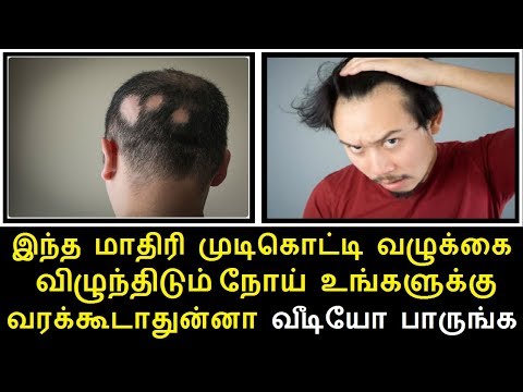 இந்த மாதிரி முடிகொட்டி வழுக்கை விழுந்திடும் நோய் Alopecia உங்களுக்கு வரக்கூடாதுன்னா வீடியோ பாருங்க