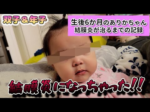 【結膜炎】朝起きたら目がゾンビみたいになってた！生後6か月赤ちゃんの結膜炎が治るまでの記録。