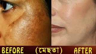 স্থায়ীভাবে মেছতা দূর করার ঘরোয়া উপায়। screenshot 2