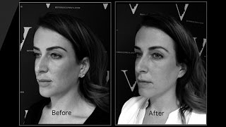 Revere Clinics Use Hyalase To Correct Fillers That Have Gone Wrong