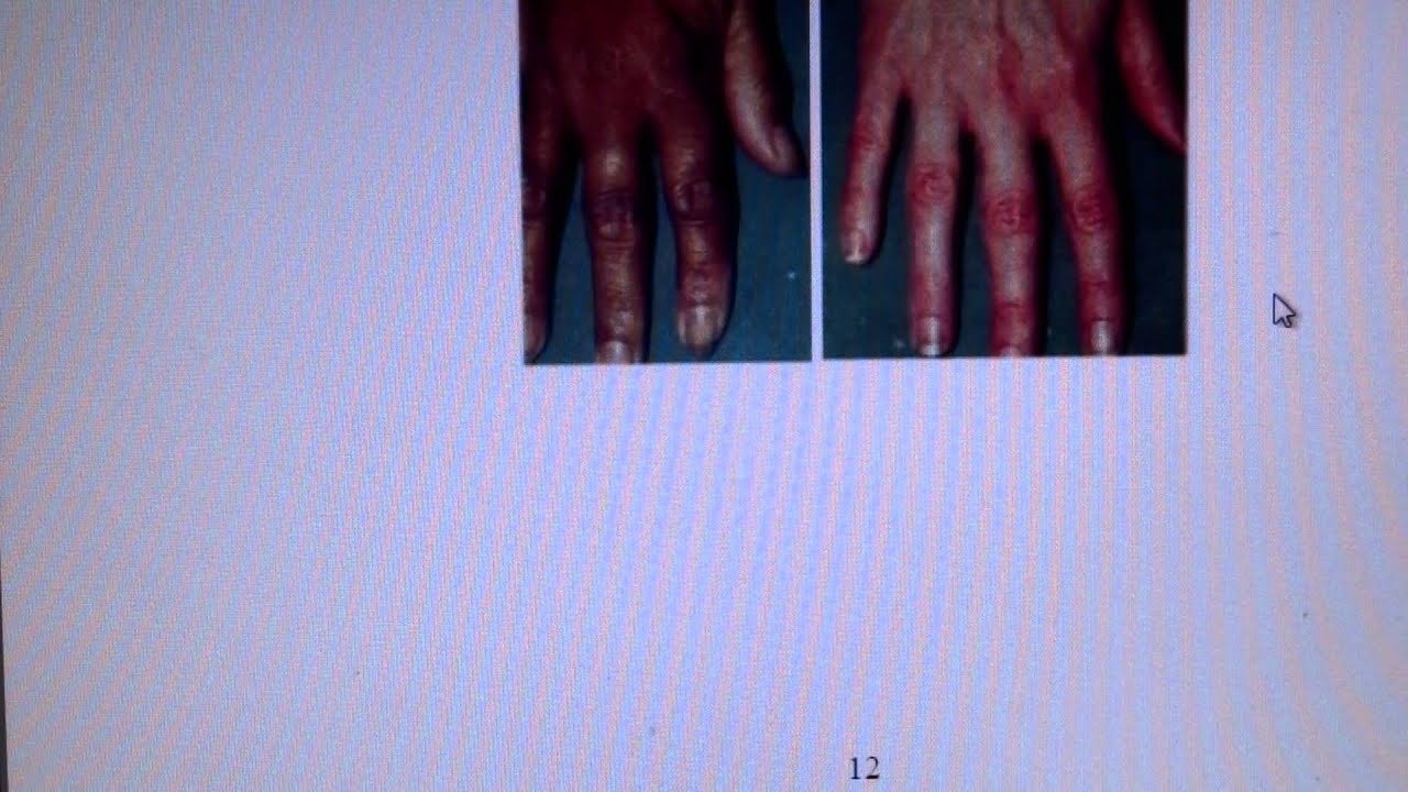 最も選択された アジソン病爪画像