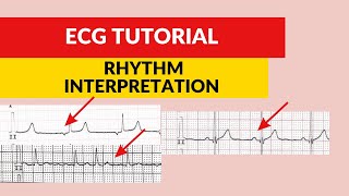 Heart rhythm ECG/EKG interpretation. Sinus rhythm. Nodal rhythm. Atrial fibrillation.