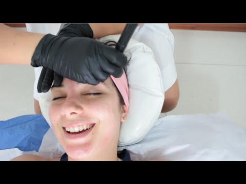 Retorno após microagulhamento e realização de peeling