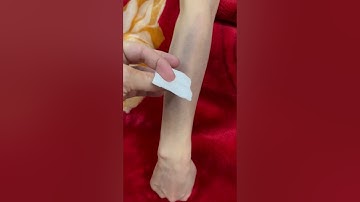 Tại sao cạo gió bạc lại cứ ra đen mãi   Bọ cạp bạc Bách Chi